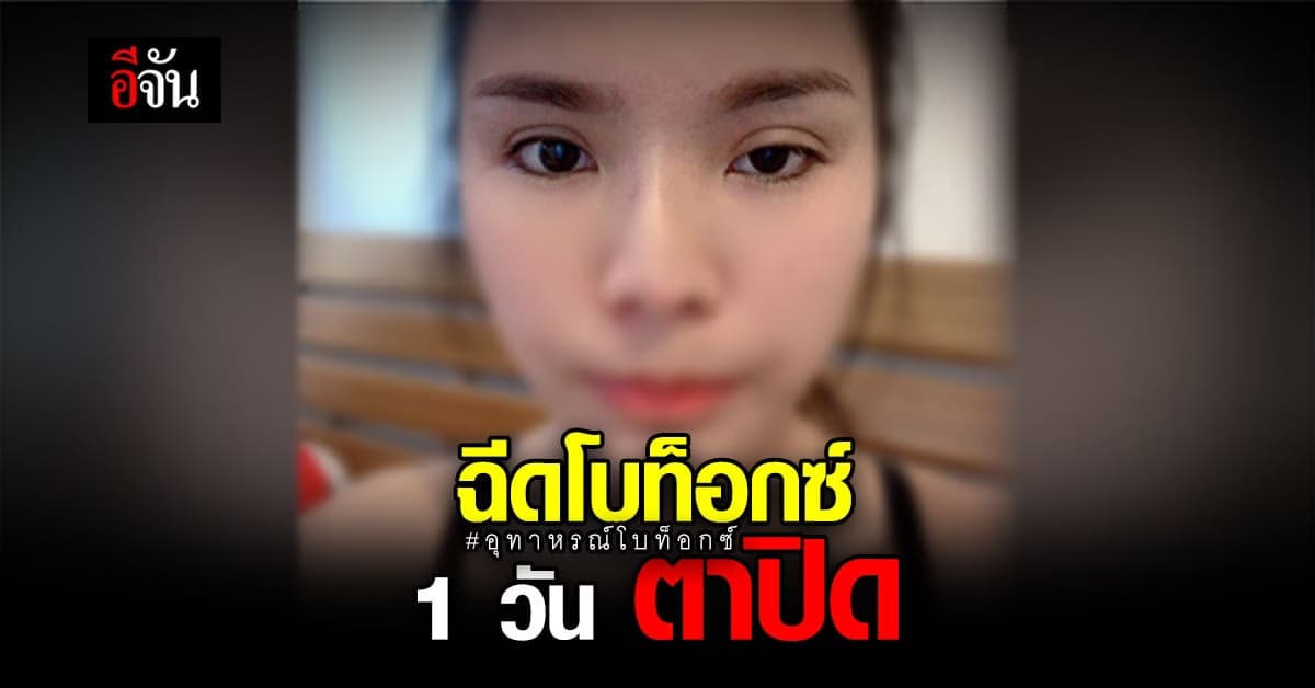 สาวโพสต์ ! เตือนภัย หลังฉีดโบท็อกซ์ 1 วัน ตาปิด