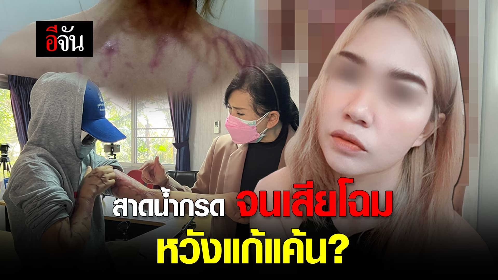 คลิป : สาดน้ำกรด จนเสียโฉม หวังแก้แค้น?