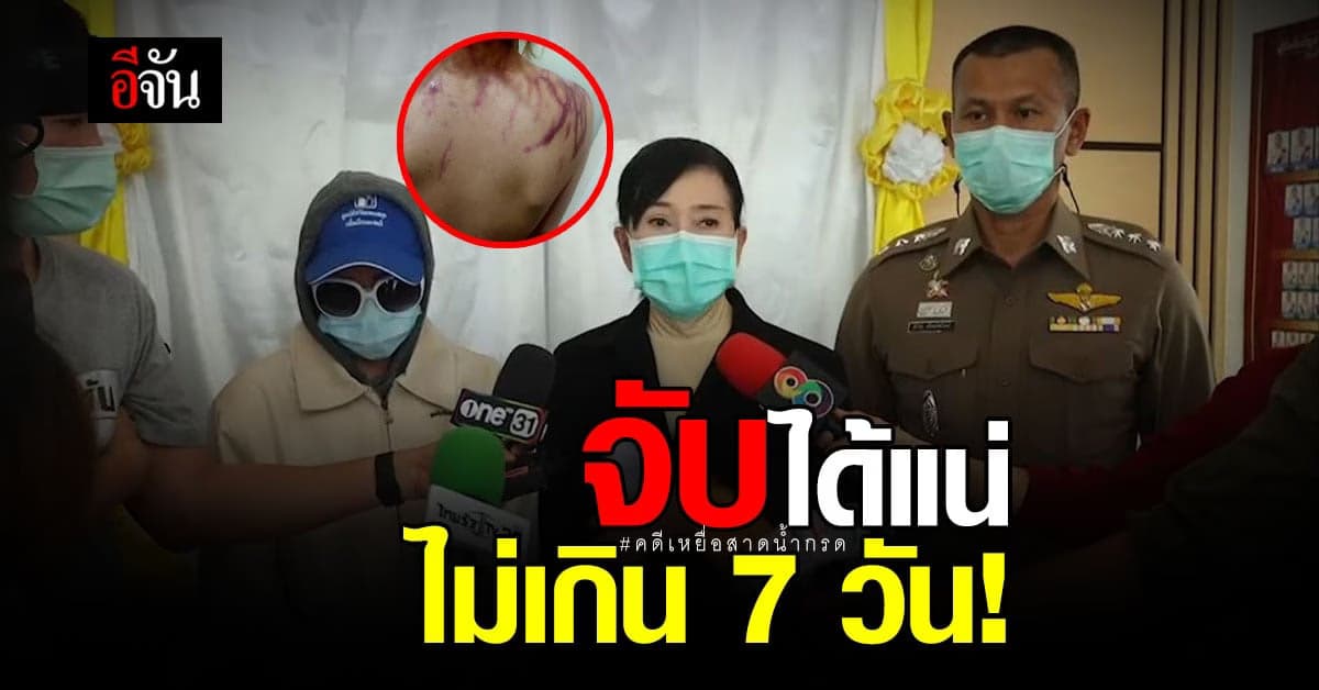 เหยื่อสาดน้ำกรด 3 เดือน คดีไม่คืบ ปวีณาฯ ประสาน สภ.หนองปรือ เร่งรัดคดี