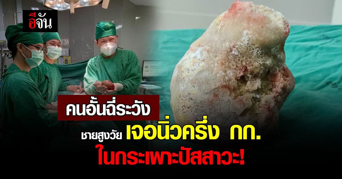 หมอโพสต์ภาพนิ่วครึ่งโล ในท่อปัสสาวะชายสูงวัย ชี้เหตุอั้นฉี่บ่อย