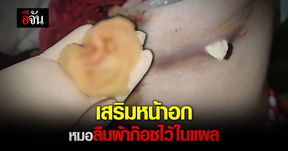 สยอง! สาวเสริมหน้าอก หมอสะเพร่า ลืมผ้าก๊อซไว้ในแผล