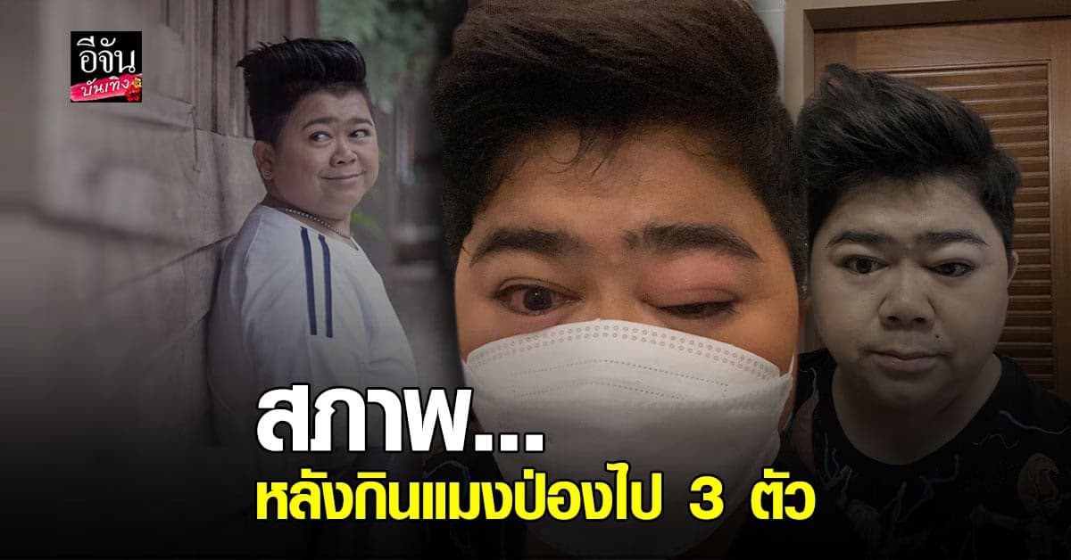 โก๊ะตี๋ พบหมอด่วน หลัง ตาบวม หน้าบวม เพราะ กินแมงป่อง