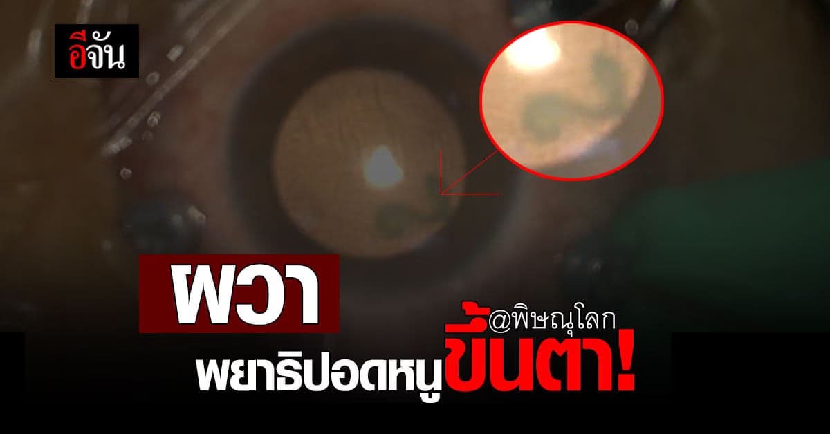 พยาธิปอดหนู ขึ้นตา รักษาไม่ทัน ตาบอดสนิท เหตุ ชอบกินของสุกๆดิบๆ