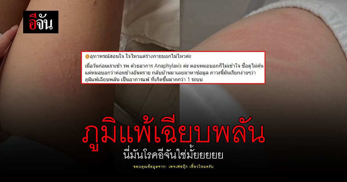 ภูมิแพ้เฉียบพลัน อุทาหรณ์สอนใจ จากผู้ใช้ เพจเฟซบุ๊ก