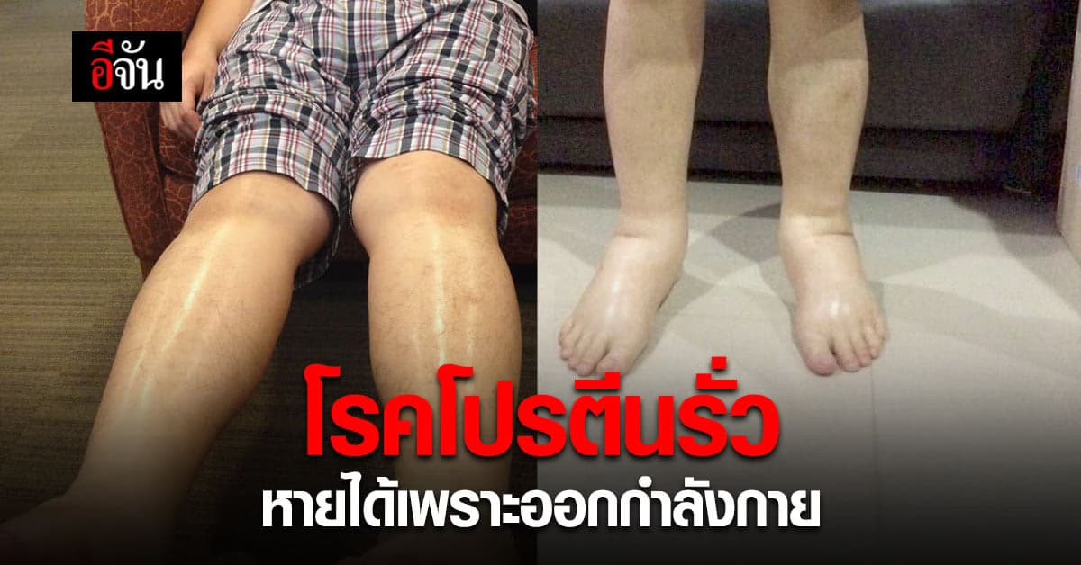 อุทาหรณ์ ป่วยโรคโปรตีนรั่ว อ้วนขึ้น ฉี่เป็นฟอง