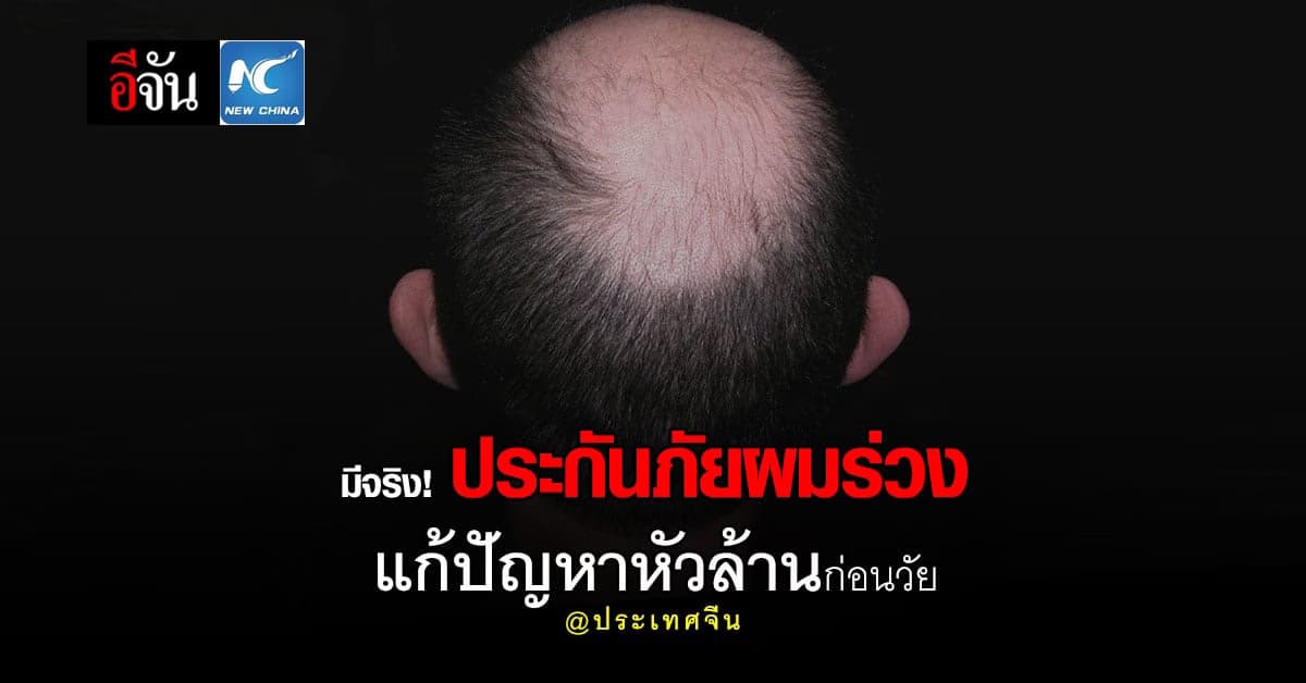 บริษัทจีนเปิดตัว “ประกันภัยผมร่วง” หลังคนหนุ่มสาวเสี่ยงหัวล้านเร็วขึ้น