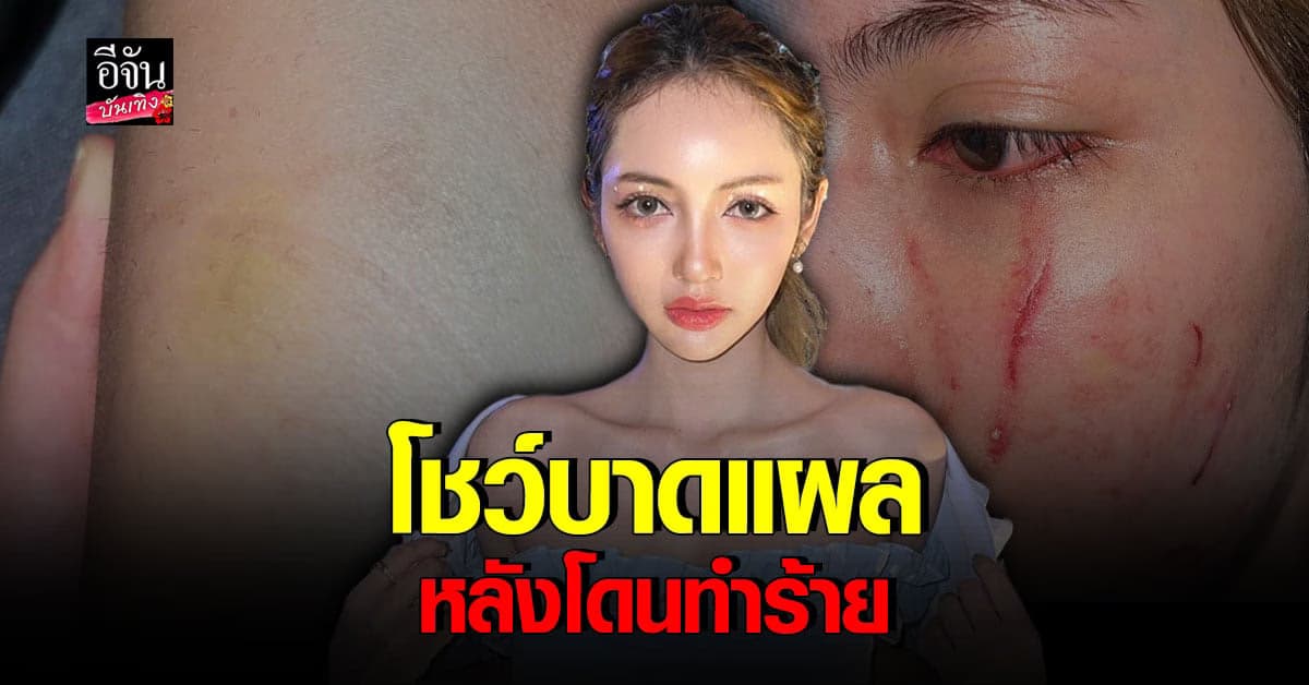 โนอา ภญมณ ว่าที่นางเอก โอดโดนทำร้ายร่างกาย ทำเสียงาน