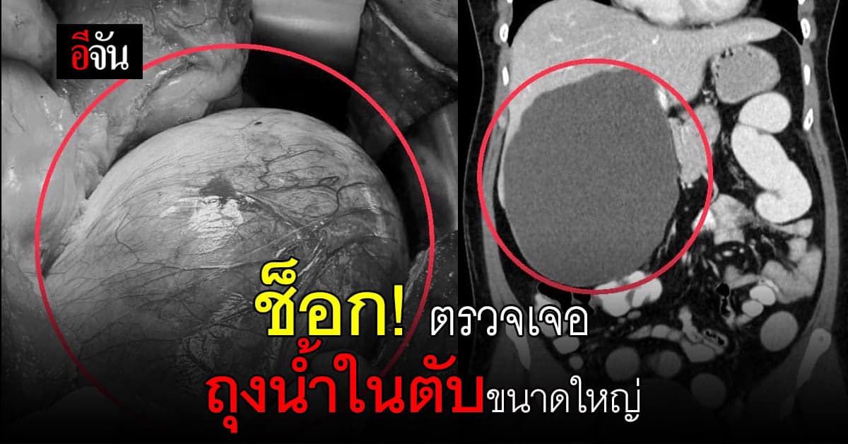 หมอเตือน! ผู้ป่วยท้องอืด-แน่นท้อง ตรวจเจอถุงน้ำในตับใหญ่ 20 ซม.