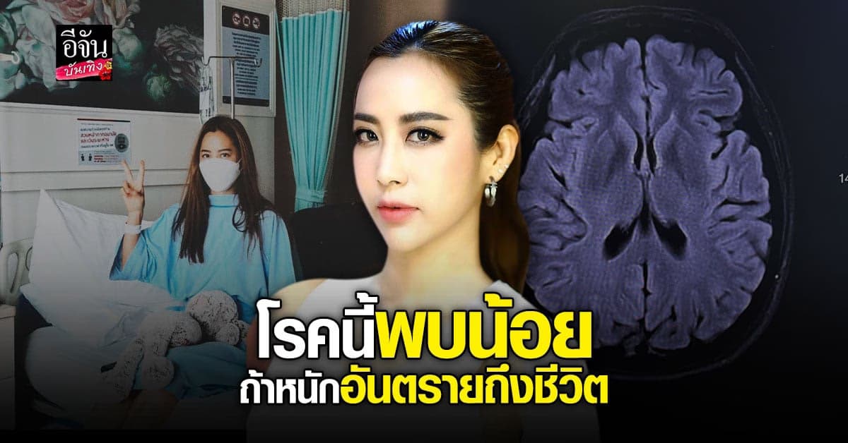 วีเจจ๋า แชร์ประสบการณ์หลังเข้า ผ่าตัดทอนซิน อึ้งเป็นโรคที่คนเป็นน้อย