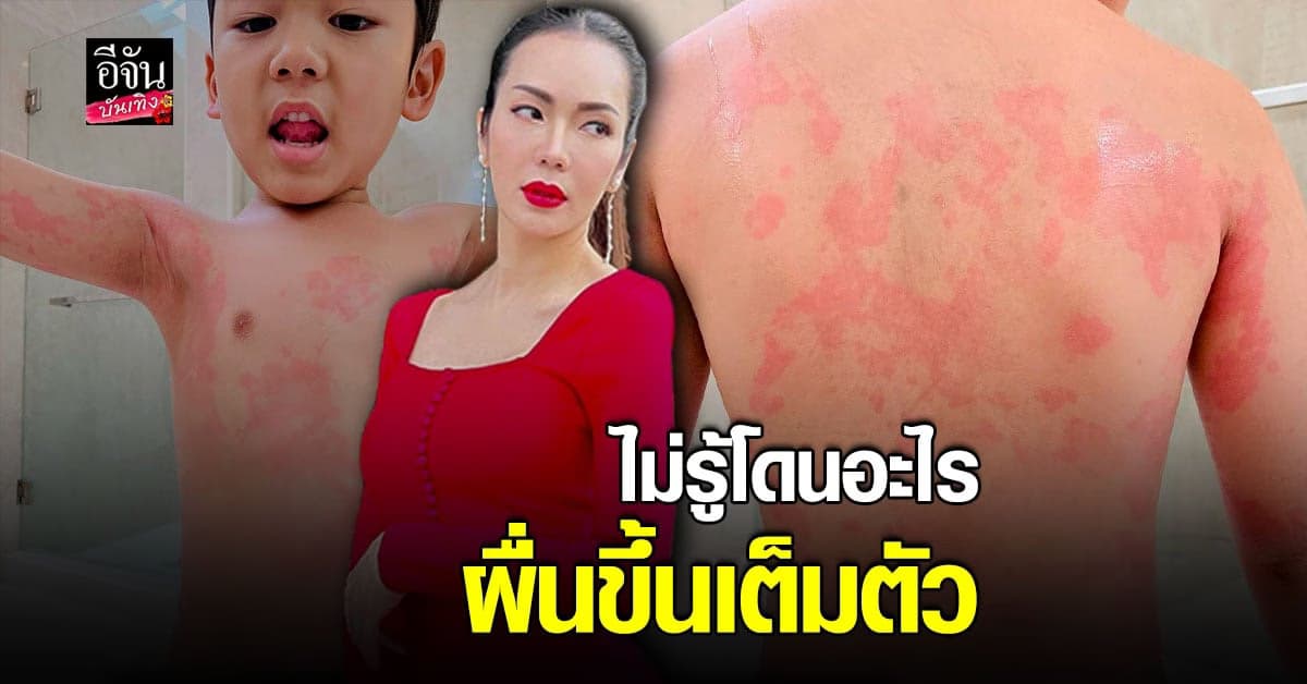 หัวอกแม่สุดห่วง น้องจอมทัพ ลูกชาย อ๋อม สกาวใจ ผื่นแดงขึ้นเต็มตัว