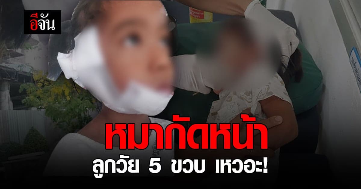 หมากัดลูกสาว หน้าเหวอะ เย็บ 24 เข็ม วอนเจ้าของรับผิดชอบ!