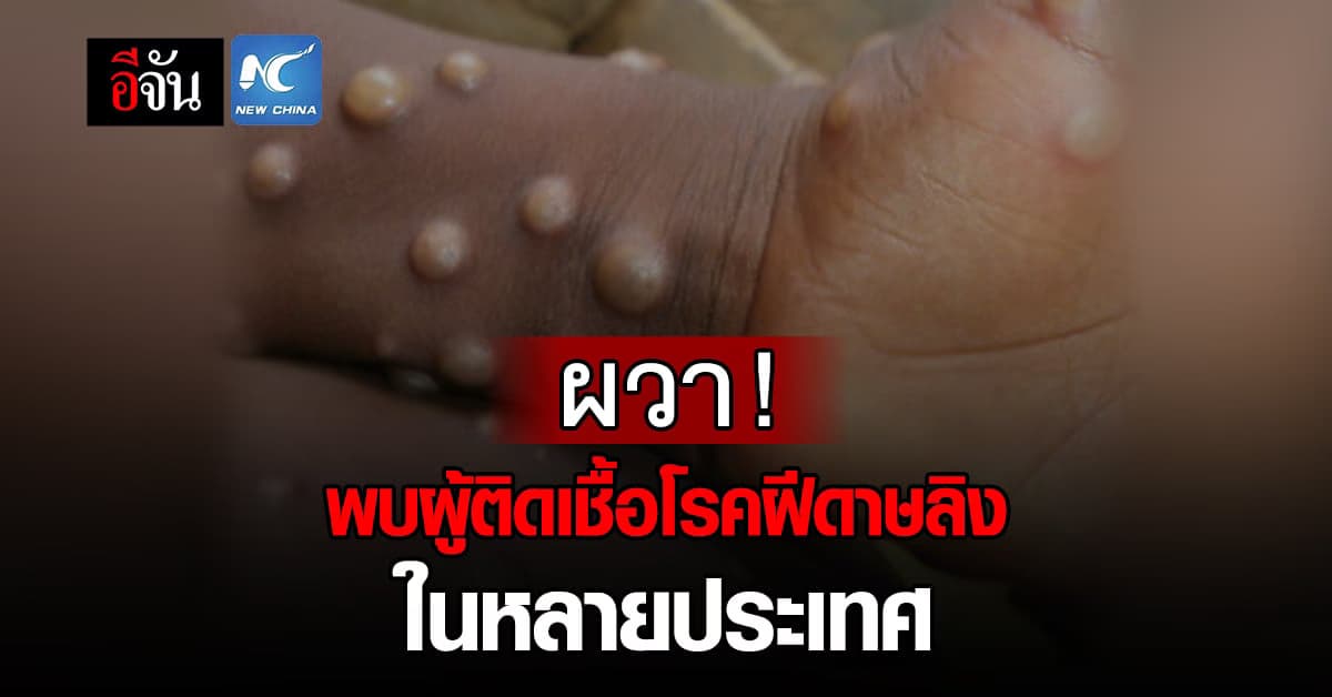 สาธารณสุขหลายประเทศต่างเฝ้าติดตาม การแพร่ระบาด ผู้ติดเชื้อ โรคฝีดาษลิง