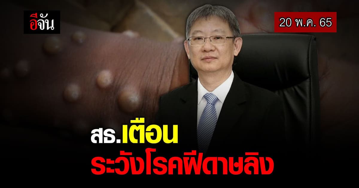 กรมควบคุมโรค เผย โรคฝีดาษลิง มีโอกาสติดน้อยแต่ต้องเฝ้าระวัง