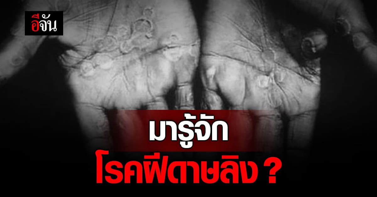 เช็กข้อมูล ข้อควรรู้ โรคฝีดาษลิง (Monkeypox) เตรียมรับมืออย่างมีสติ