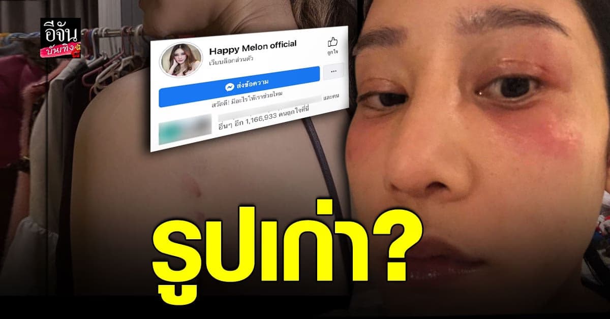 โซเชียลวิจารณ์หนัก หลังเพจ ​​แตงโม เผยภาพตาช้ำ อ้างถูกทำร้าย