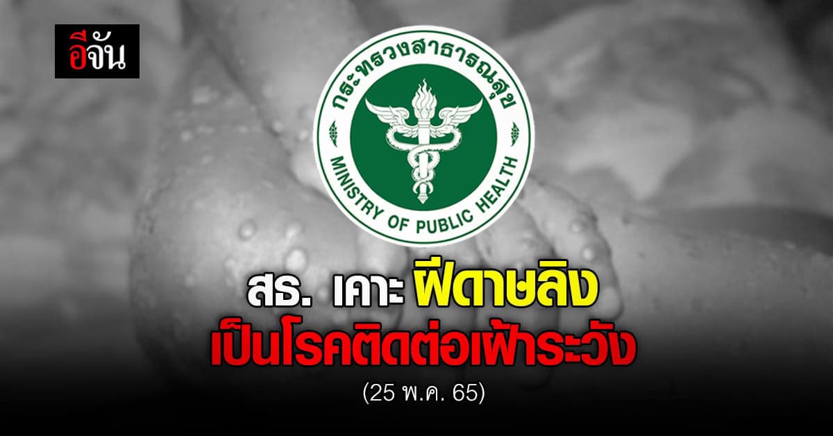 สธ. เห็นชอบ ให้ ฝีดาษลิง เป็นโรคติดต่อ เฝ้าระวัง แม้ ยังไม่พบในไทย