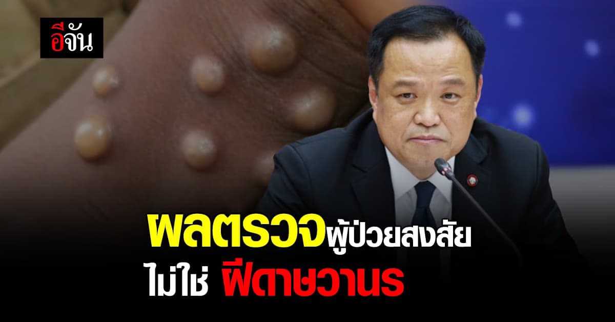 อนุทินเผย ผลตรวจ ผู้ป่วยสงสัย จากประเทศเฝ้าระวัง ยังไม่พบ ฝีดาษวานร