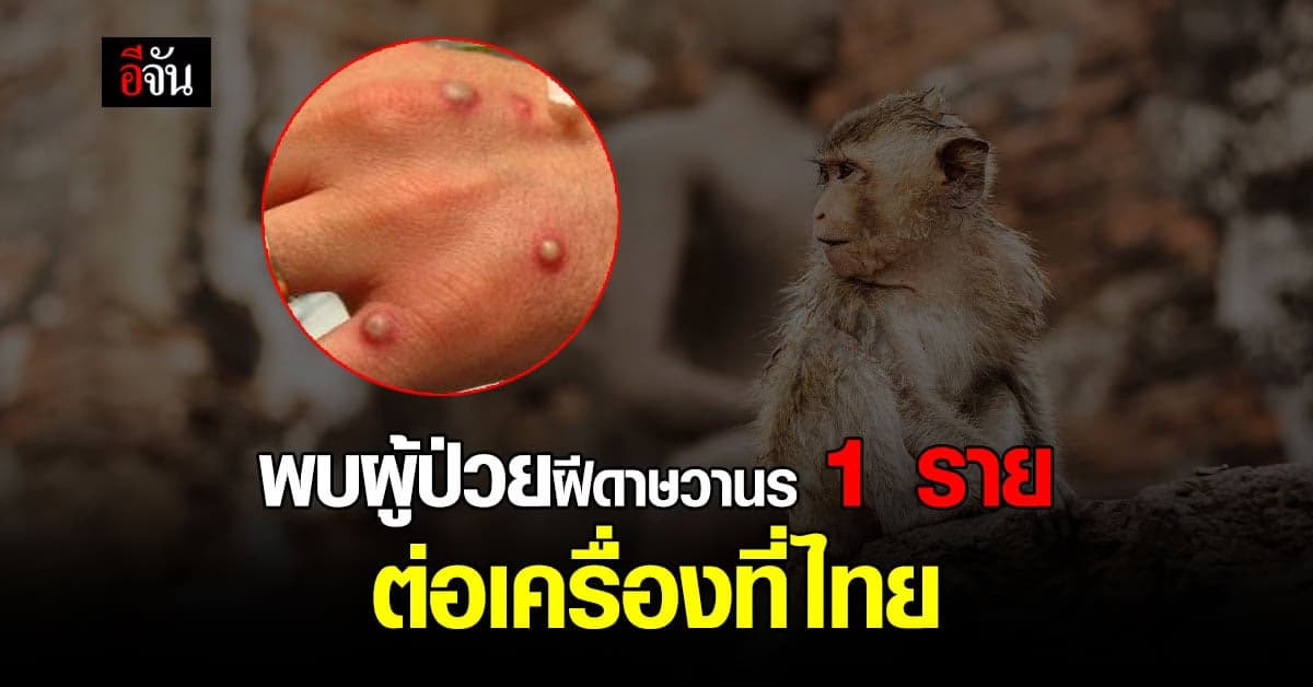 สธ. เเถลง พบผู้ป่วยฝีดาษวานร 1 ราย เเวะเปลี่ยนเครื่องที่ไทย