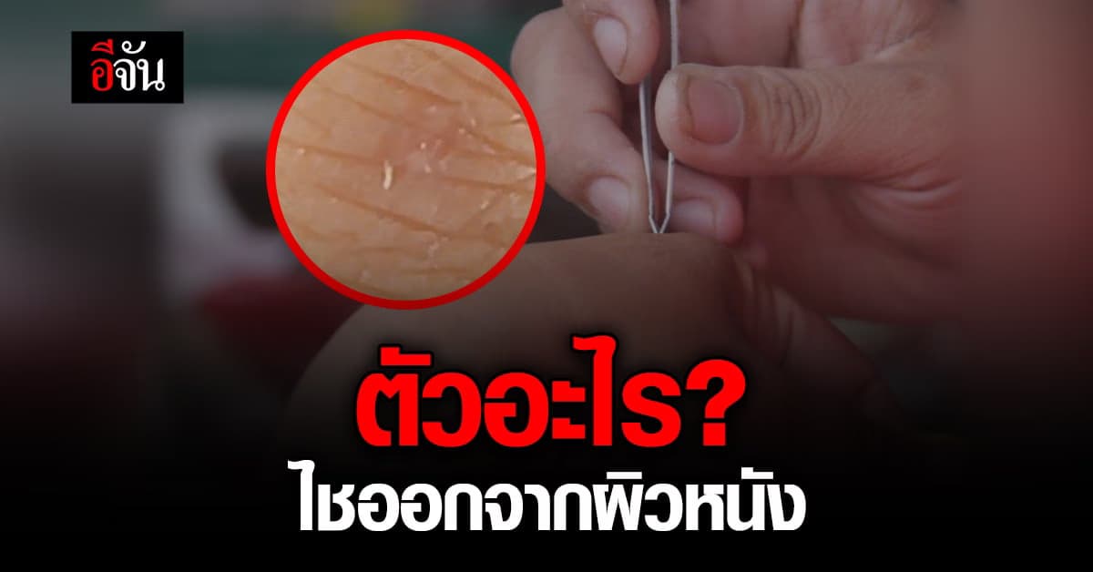สาวอุดรวอนช่วย! พบตัวประหลาดคล้ายหนอนไชออกจากผิวหนัง