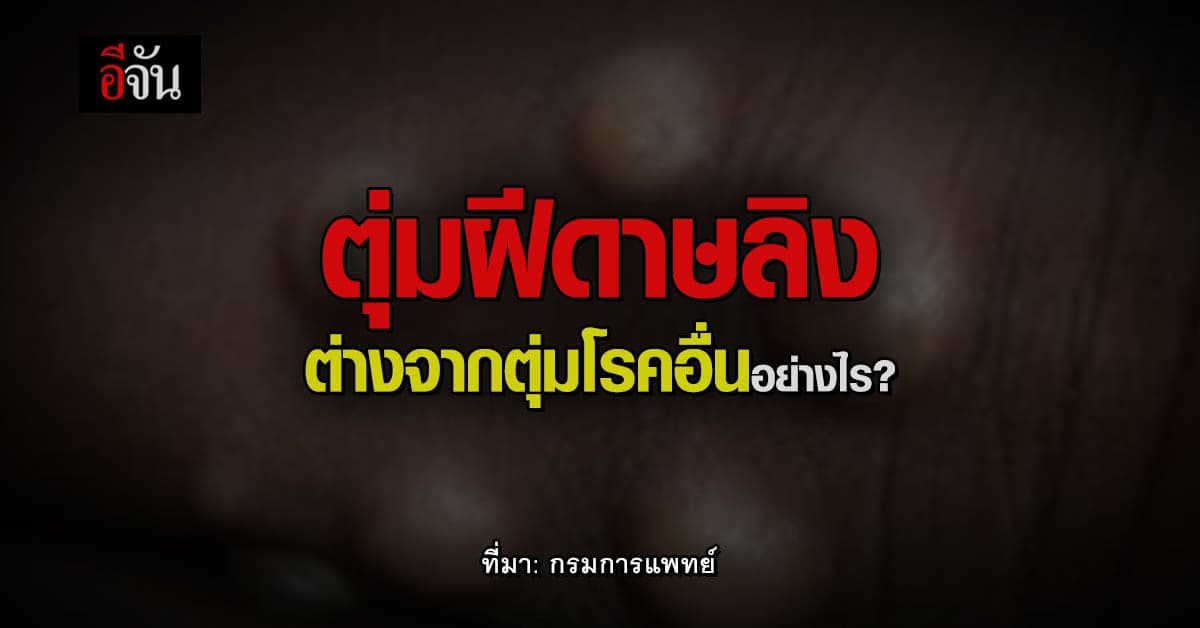กรมการแพทย์ โดยสถาบันโรคผิวหนัง ชี้ความต่าง ตุ่มฝีดาษลิงกับโรคอื่น