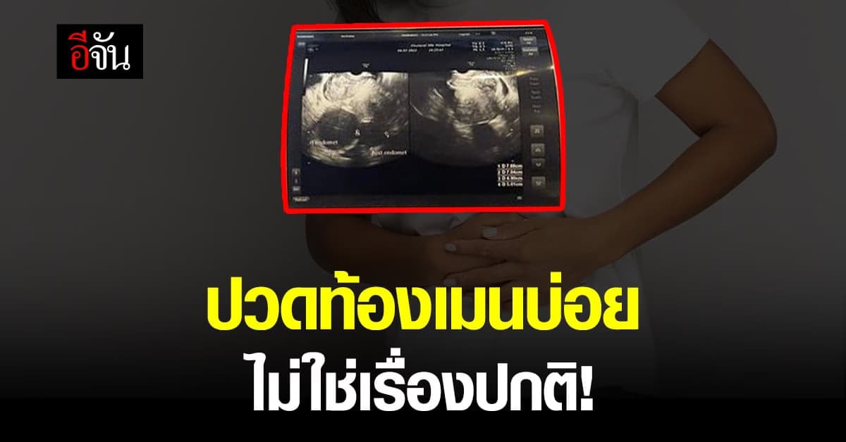 อุทาหรณ์ ปวดท้องเมนส์ เจอทั้งช็อกโกแลตซีสต์ เนื้องอกเกาะบนมดลูก !