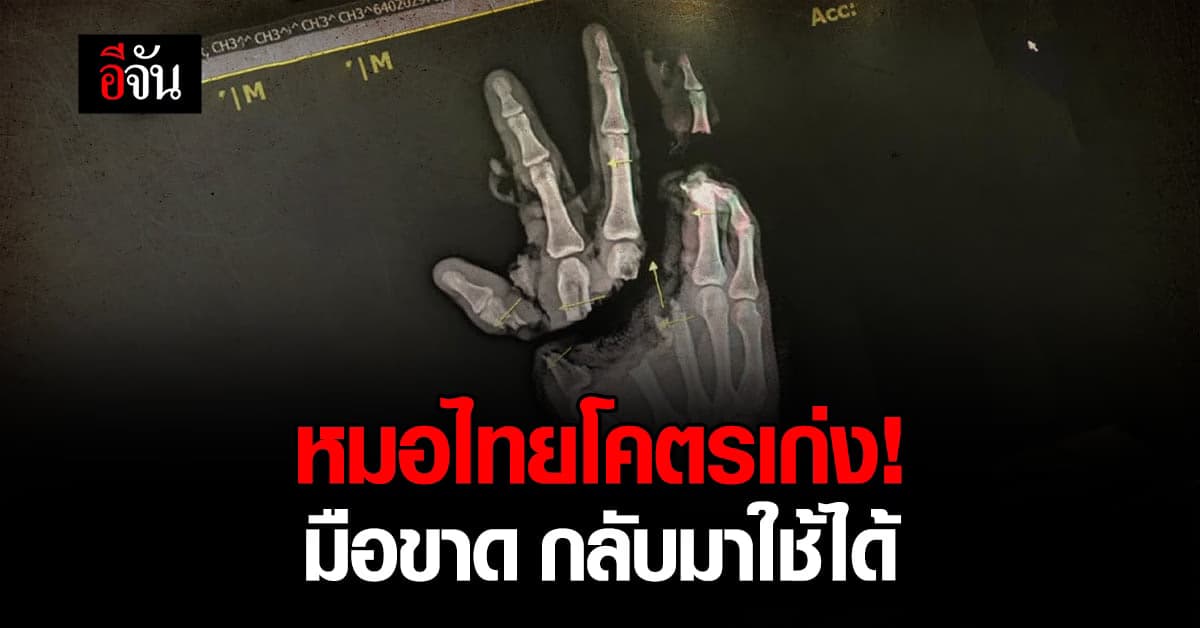 หมอไทยเก่ง สุดยอด! มือขาดครึ่ง ยังผ่าตัดแก้ไข จนกลับมาใช้งานได้