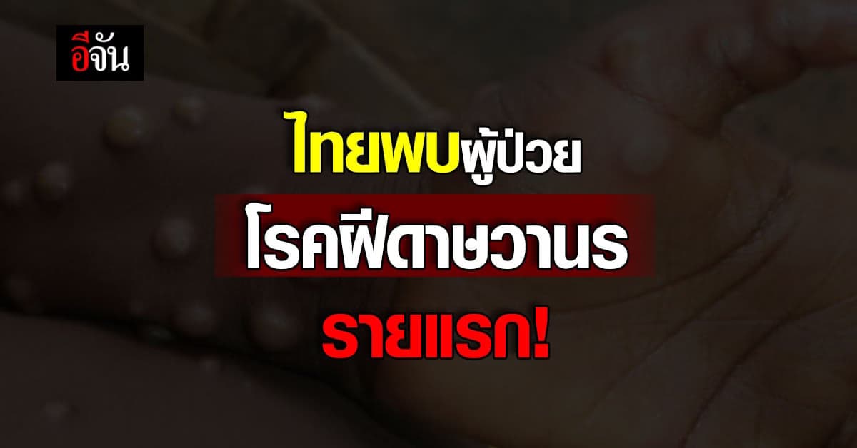ไทยพบผู้ป่วย โรคฝีดาษวานร รายแรก! ที่จ.ภูเก็ต