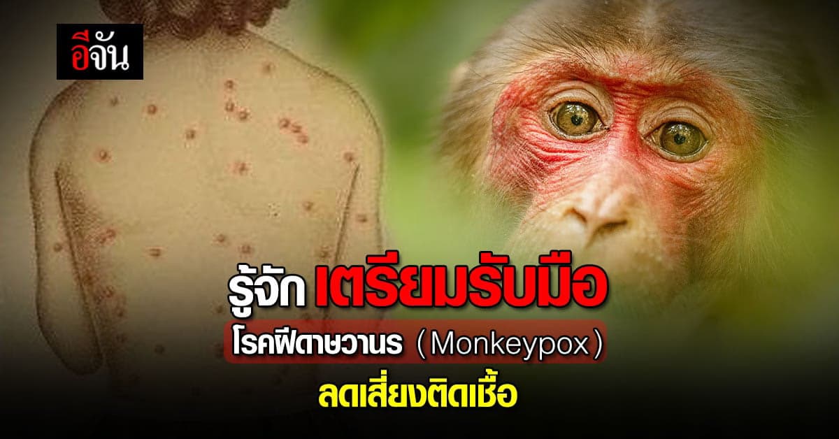 เตรียมรับมือ โรคฝีดาษวานร ( Monkeypox ) พร้อมสังเกตอาการ ลดโอกาสเสี่ยง