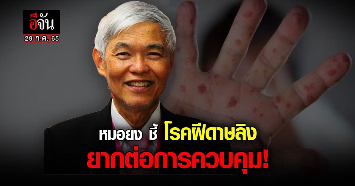 หมอยง ชี้ โรคฝีดาษลิง ยากต่อการควบคุม