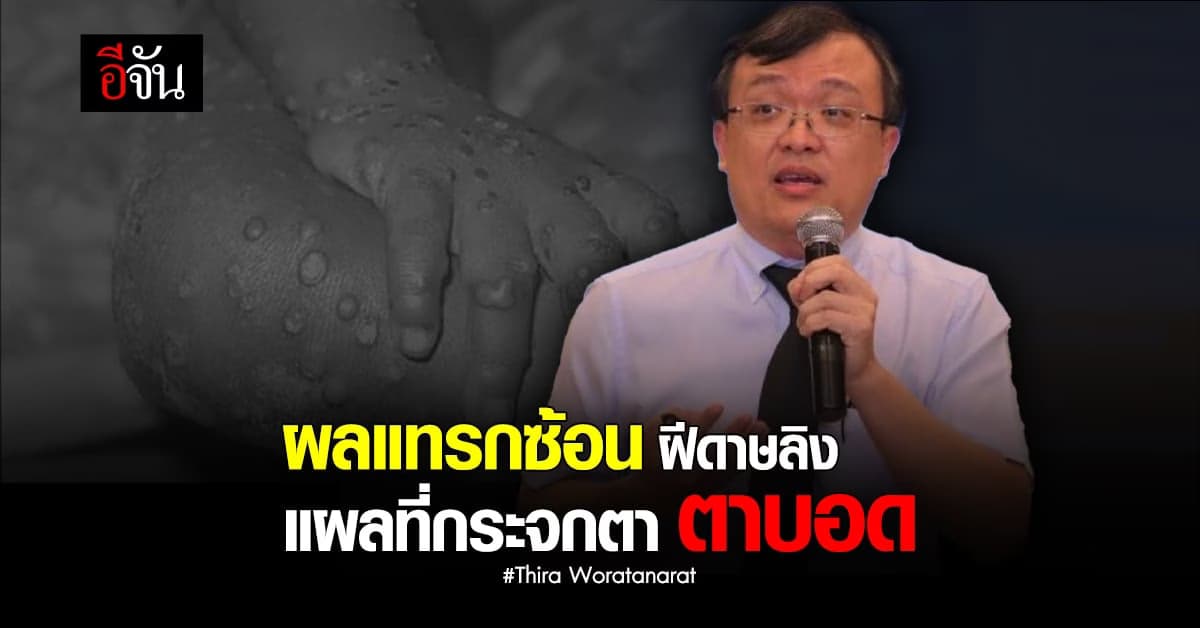 นพ.ธีระ ชี้ผลแทรกซ้อน ฝีดาษลิง แผลที่กระจกตา ตาบอด