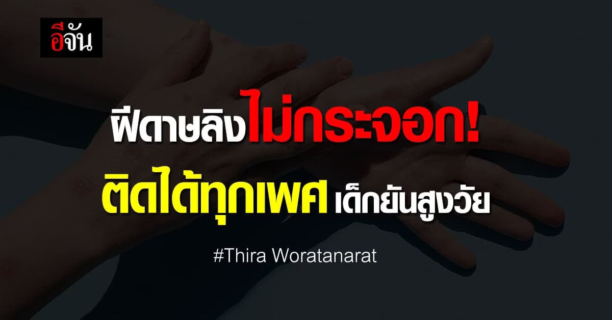 โรคฝีดาษลิง ไม่กระจอก ติดได้ทุกเพศทุกวัย