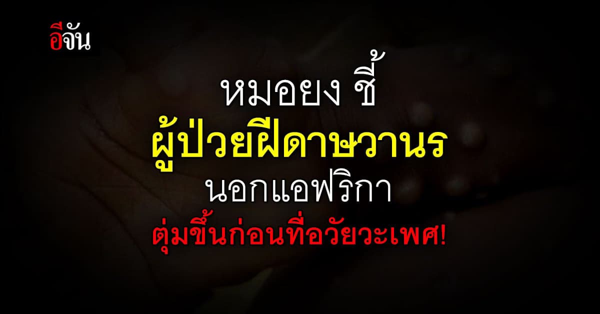 หมอยง ชี้ ผู้ป่วยฝีดาษวานร นอกแอฟริกา ตุ่มขึ้นก่อนที่อวัยวะเพศ !