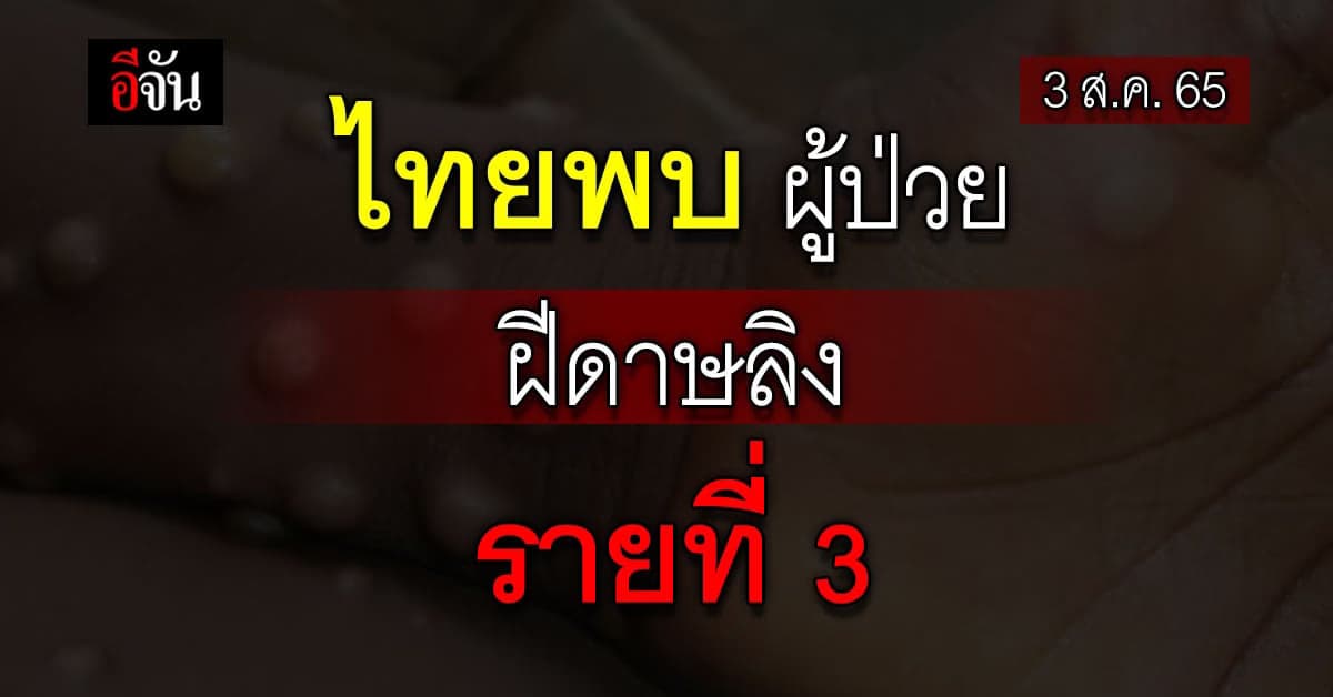 สธ. เผย ไทยพบผู้ป่วย ฝีดาษวานร รายที่ 3 ที่ ภูเก็ต เป็นชาย ชาวเยอรมัน