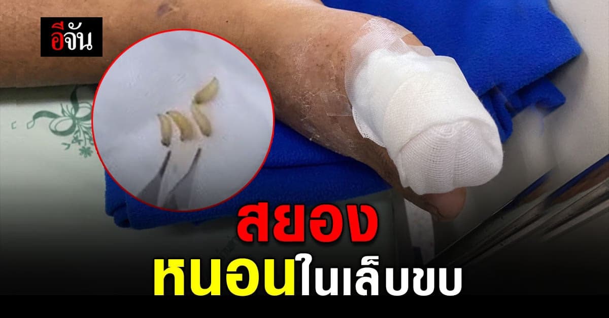 พ่อปวด เล็บขบ เรื้อรัง ลูกพาหาหมอ แทบช็อค เจอ หนอน !