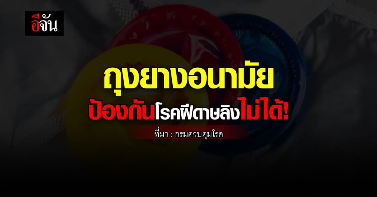 กรมควบคุมโรค ย้ำ ถุงยางอนามัย ป้องกันโรคฝีดาษลิงไม่ได้!