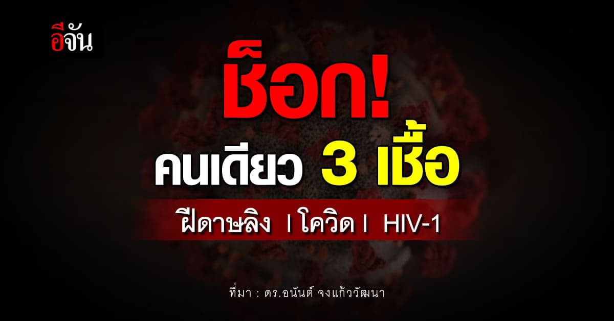 ช็อก! คนเดียว 3 เชื้อ ฝีดาษลิง โควิด HIV-1
