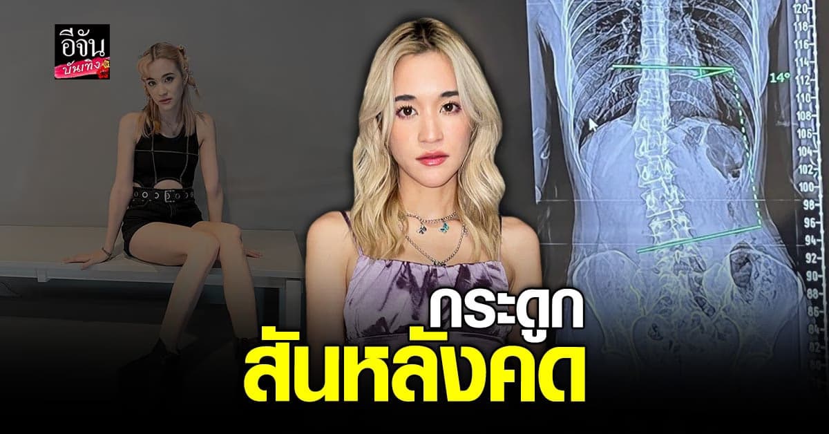 ส้ม มารี กระดูกสันหลังคต กลับมาตรงไม่ได้แล้ว ?