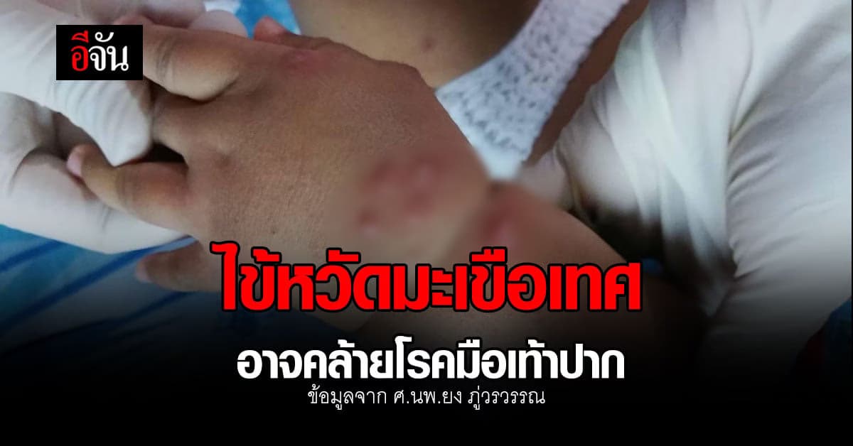 หมอยง ย้ำ ไข้หวัดมะเขือเทศ ไม่รุนแรง – หายได้เอง