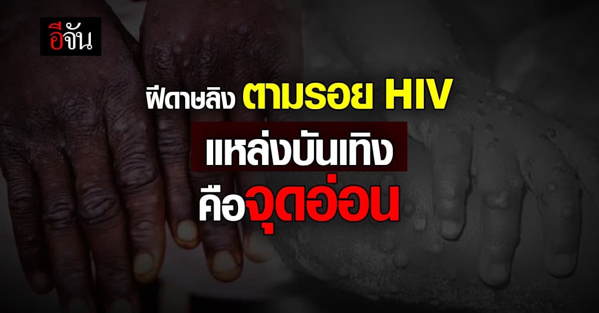 นพ.ธีระ ชี้ฝีดาษลิง ตามรอย HIV มีการแพร่ระบาดคล้ายกัน