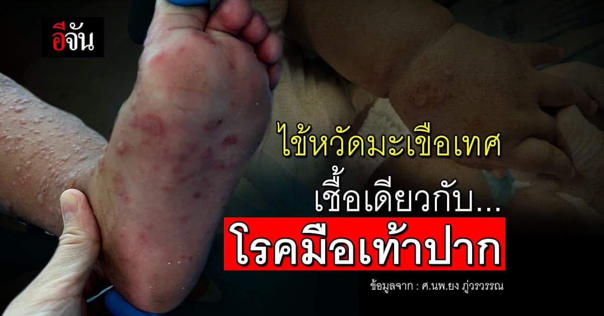 หมอยง เผย ไข้หวัดมะเขือเทศ เชื้อเดียวกับโรคมือเท้าปาก