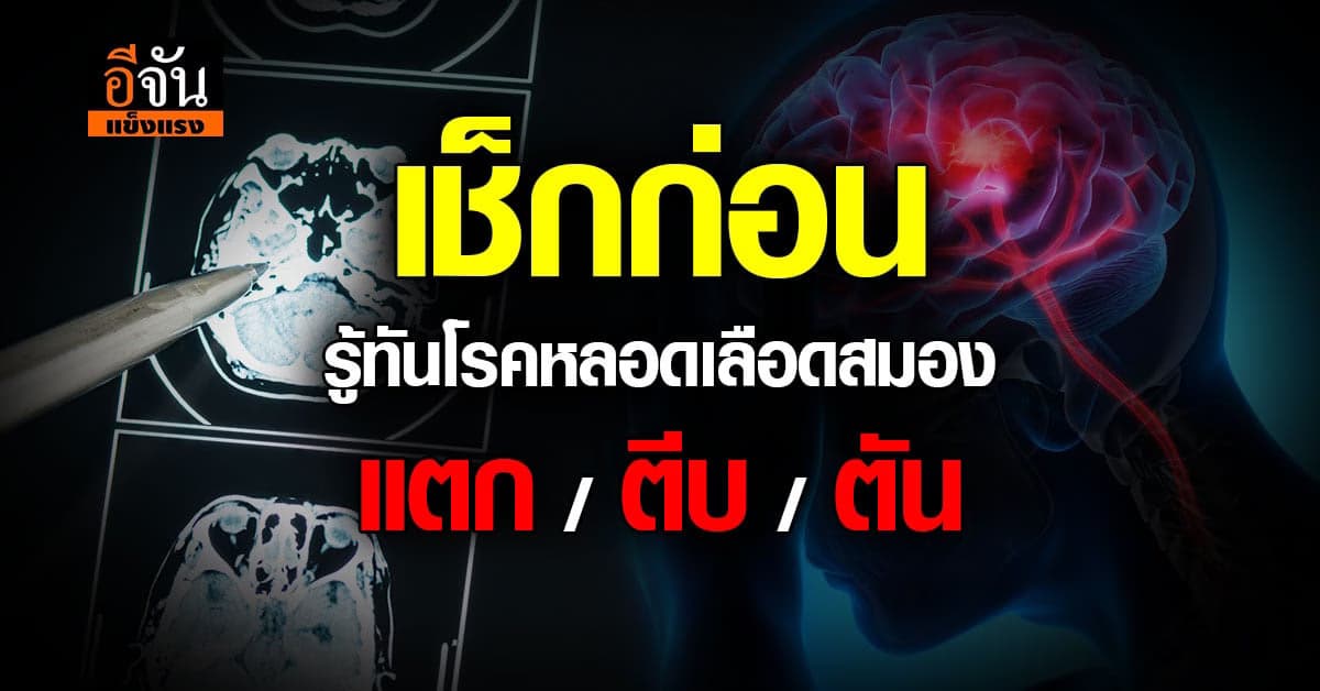รู้จัก รู้ทัน เลี่ยงเสี่ยง โรคหลอดเลือดสมองตีบ แตกหรืออุดตัน