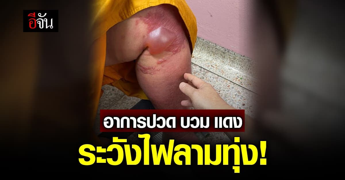 อุทาหรณ์ อาการบวมเเดง รักษาช้า อาจเกิดการติดเชื้อ