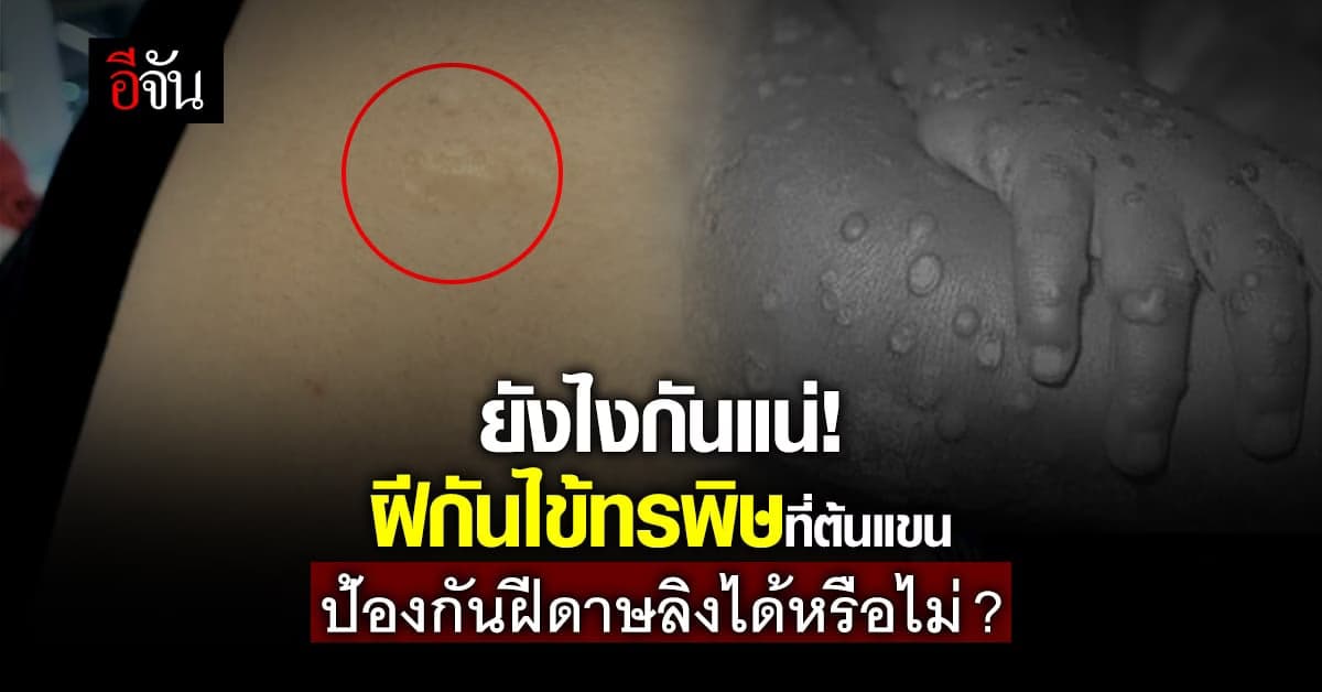 ปลูกฝีป้องกันไข้ทรพิษ 40 ปีก่อน กันฝีดาษลิงได้ไหม?
