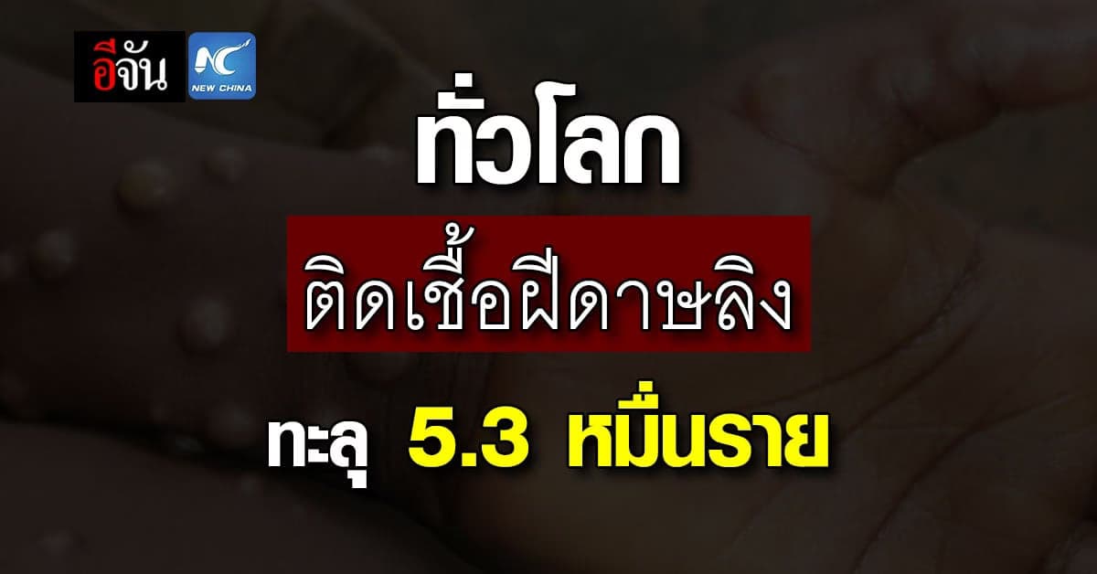 สหรัฐฯ ติดเชื้อฝีดาษลิงมากที่สุดในโลก