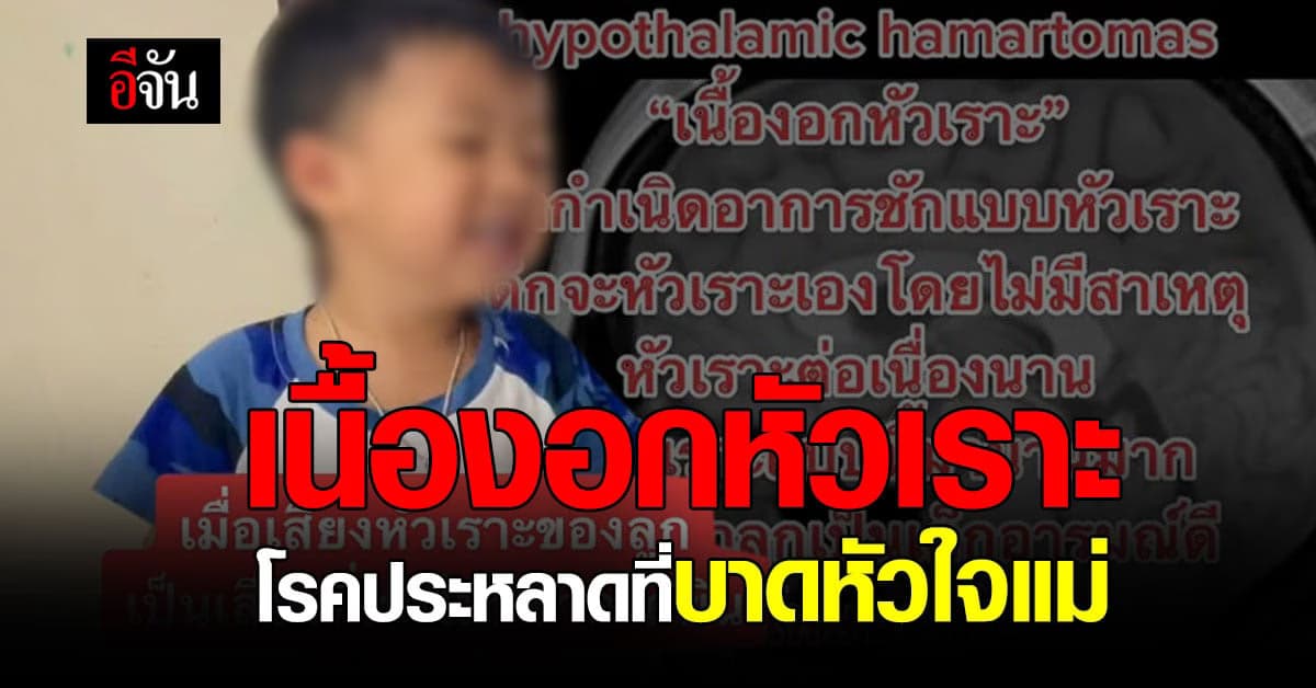 บีบหัวใจแม่! โรคประหลาด เนื้องอกหัวเราะ ลูกหัวเราะจนชัก