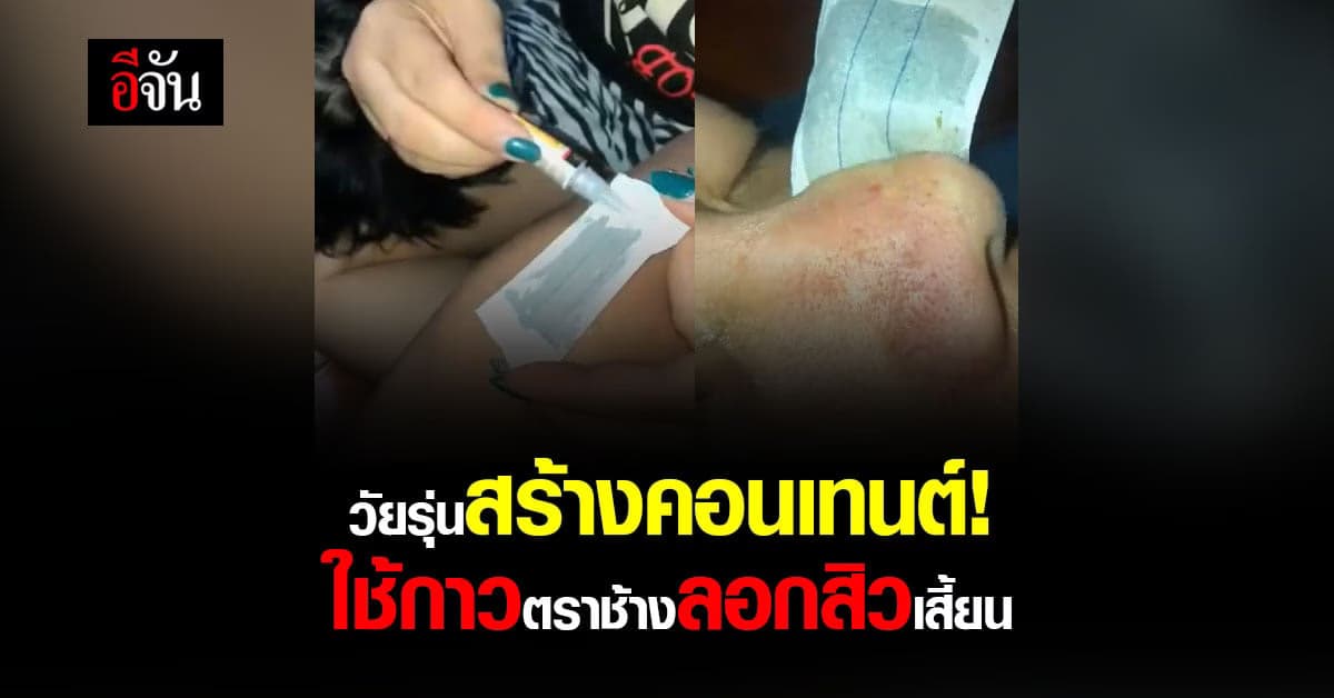 อย่าหาทำ! วัยรุ่นสร้างคอนเทนต์ ใช้กาวตราช้างลอกสิวเสี้ยน