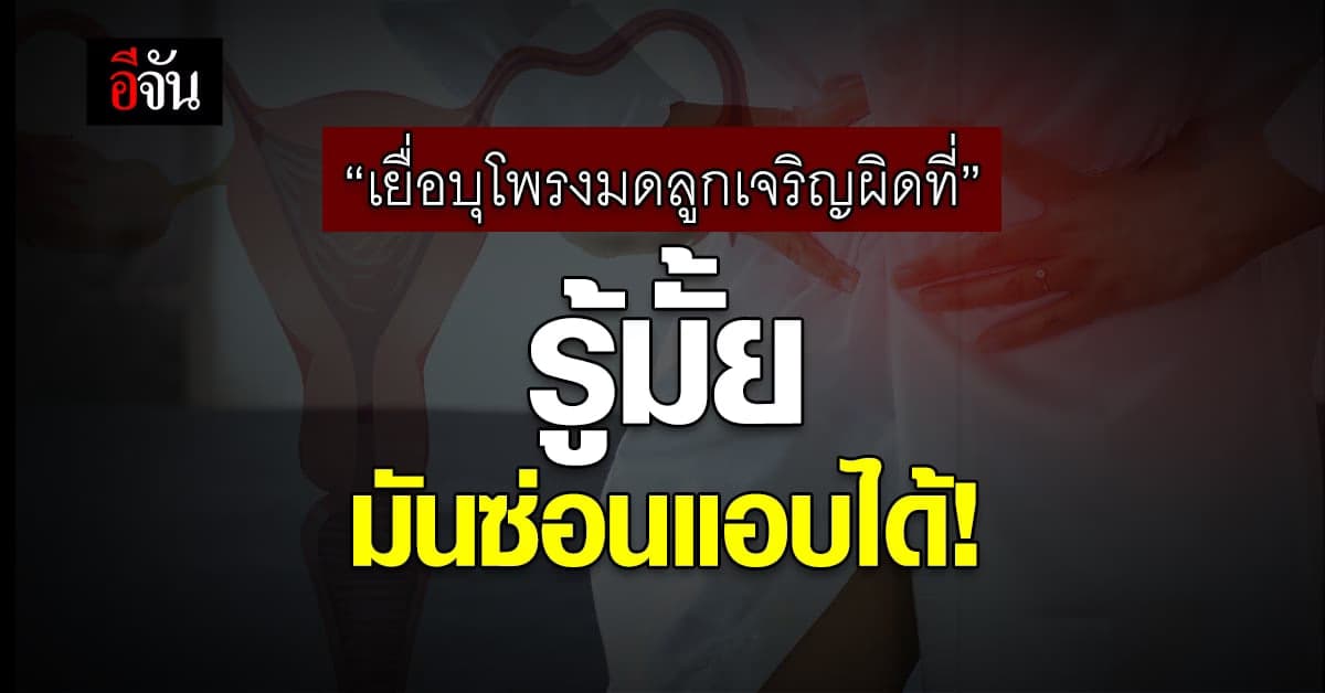 ผู้หญิงควรระวัง! เยื่อบุโพรงมดลูกเจริญผิดที่ แบบซ่อนแอบ