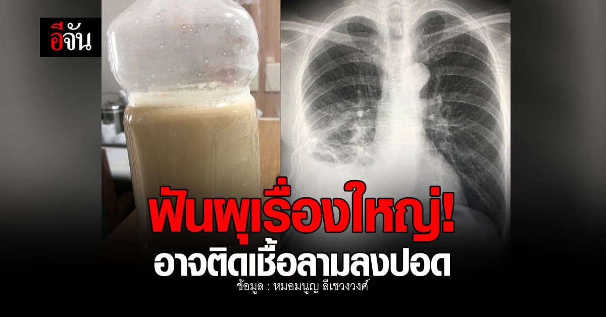 ขนลุก! ฟันผุติดเชื้อในรากฟัน หนองลามลงปอด