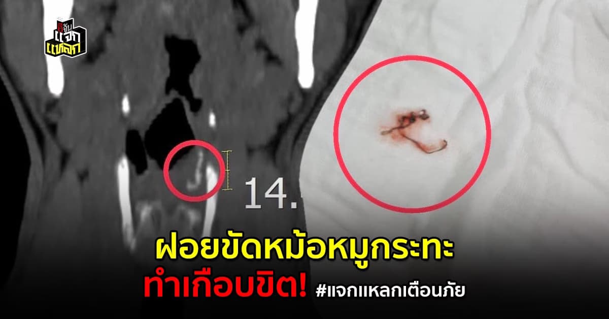 เเพทย์เตือน เจอเคสฝอยขัดหม้อ ติดคอ หลังกินหมูกระทะ