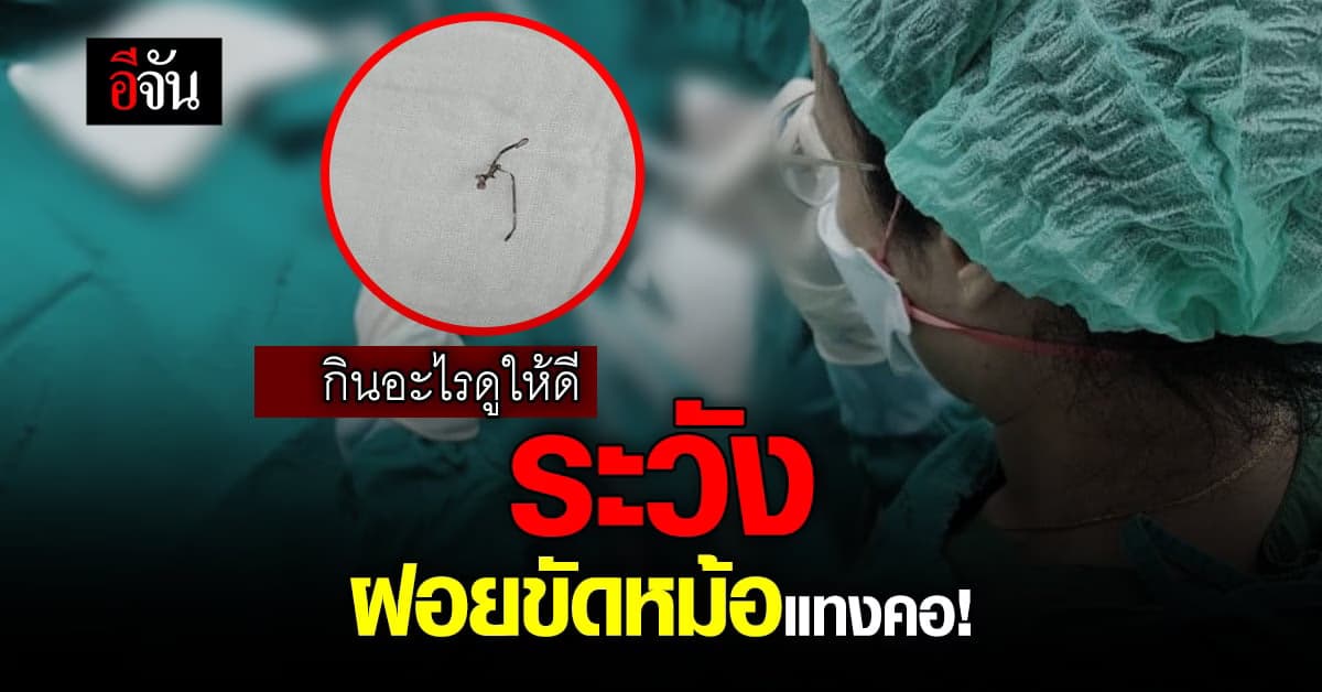 สุดช็อก! ฝอยขัดหม้อแทงคอ ต้องผ่าตัดด่วน เหตุเกิดจากหมูกระทะ